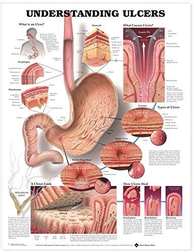 Algopix Similar Product 13 - Understanding Ulcers Anatomical Chart