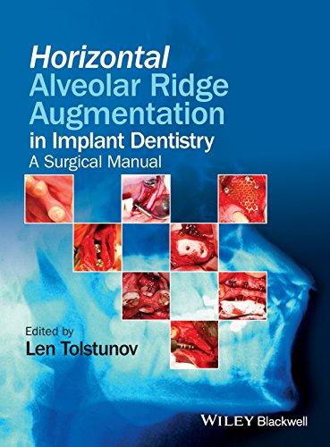 Algopix Similar Product 14 - Horizontal Alveolar Ridge Augmentation