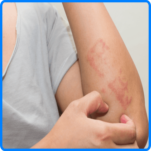 Algopix Similar Product 4 - Eczema: Symptoms, Treatment, and Causes