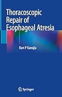 Algopix Similar Product 3 - Thoracoscopic Repair of Esophageal