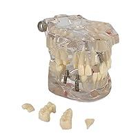 Algopix Similar Product 20 - Transparent Dental Implant Disease