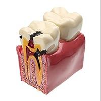 Algopix Similar Product 17 - Dental Caries Tooth Model YOUYA DENTAL