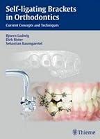 Algopix Similar Product 13 - Selfligating Brackets in Orthodontics
