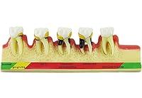 Algopix Similar Product 7 - Dental Periodontal Disease assort Tooth