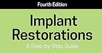Algopix Similar Product 18 - Implant Restorations A StepbyStep