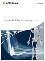 Algopix Similar Product 4 - Periprosthetic Fracture Management