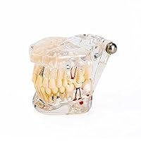 Algopix Similar Product 3 - Easyinsmile Dental Implant Disease