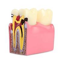 Algopix Similar Product 6 - Dental Caries Tooth Model 6 Times Decay