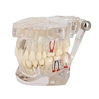 Algopix Similar Product 11 - Transparent Disease Teeth Model YOUYA