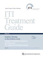 Algopix Similar Product 8 - ITI Treatment Guide Volume 10 Implant
