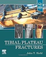 Algopix Similar Product 16 - Tibial Plateau Fractures