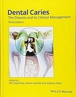 Algopix Similar Product 1 - Dental Caries The Disease and its