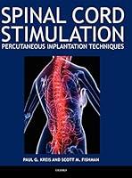 Algopix Similar Product 13 - Spinal Cord Stimulation Percutaneous