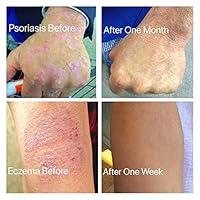 Algopix Similar Product 14 - Mitlow Herbal Eczema Soap and Balm