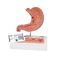 Algopix Similar Product 7 - 3B Scientific K17 Stomach w Ulcers 