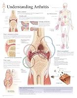 Algopix Similar Product 1 - Understanding Arthritis chart Wall