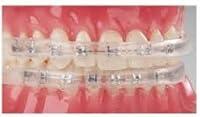 Algopix Similar Product 2 - Comfort Lip ShieldMouth Guard  for