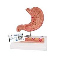 Algopix Similar Product 5 - 3B Scientific K17 Stomach w Ulcers